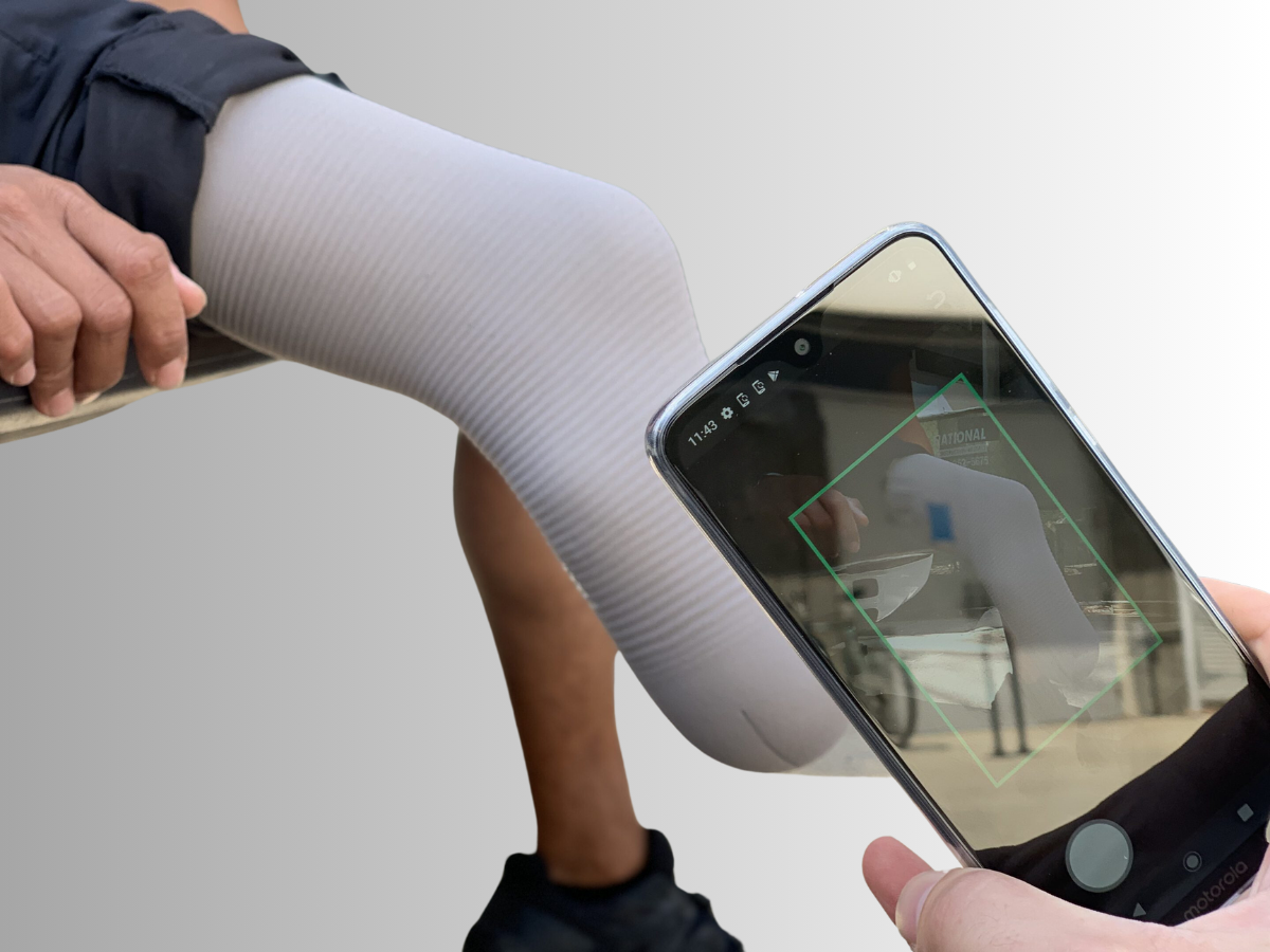 Innovative prosthetic sockets, enhancing mobility and quality of life